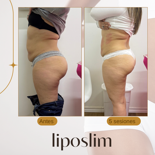 8 SESIONES LIPOSLIM