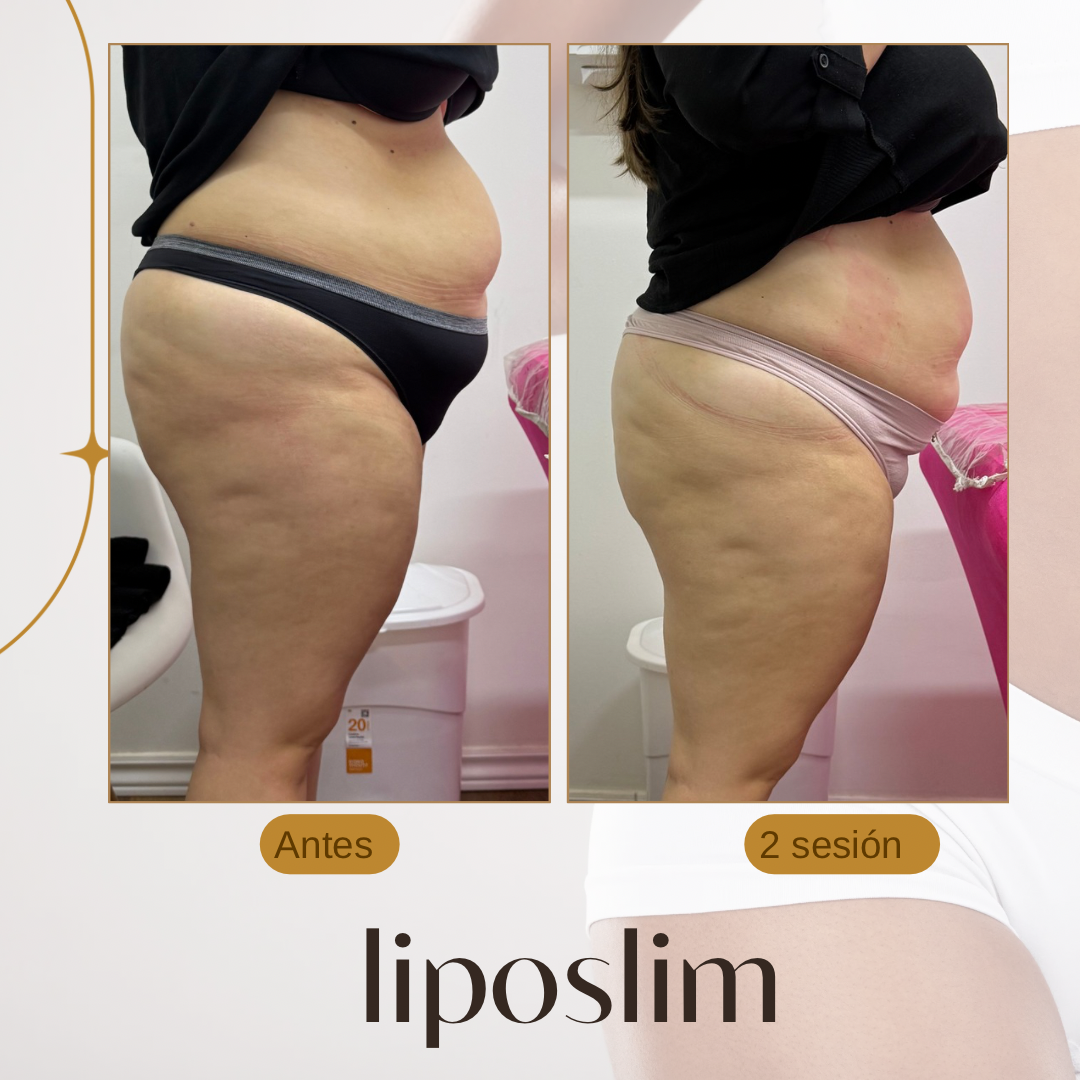 PASE LIBRE LIPOSLIM
