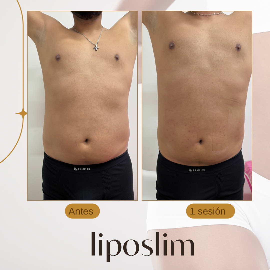 PASE LIBRE LIPOSLIM